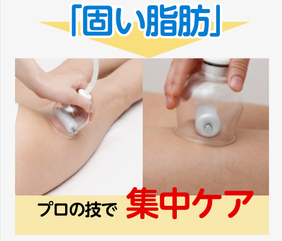 脂肪を吸引している画像